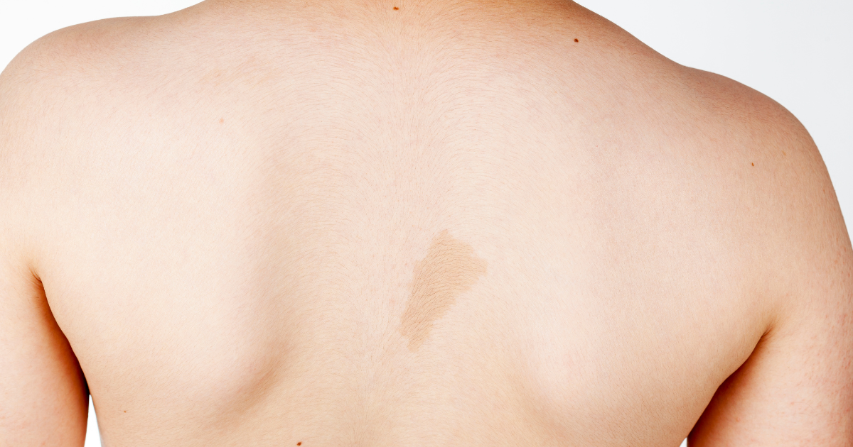Types of Birthmarks and Their Meanings